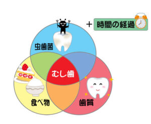 むし歯の原因