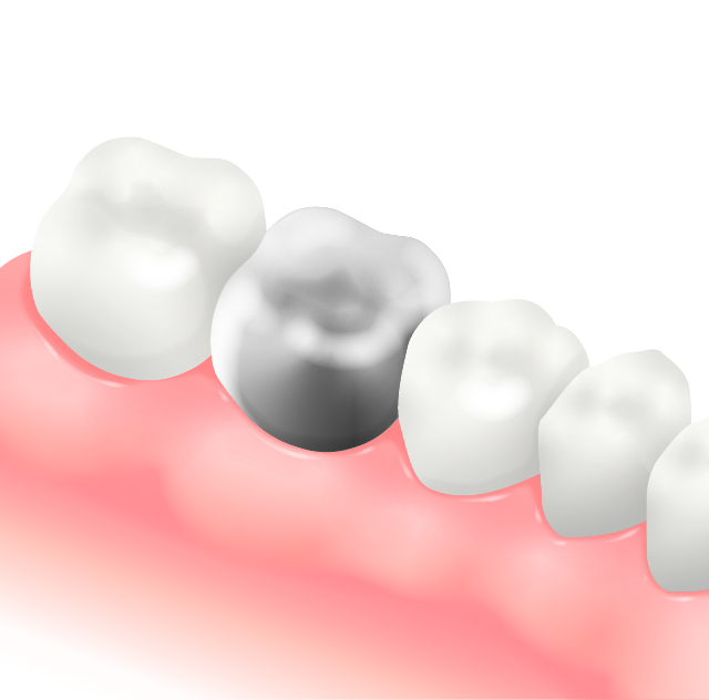 合金(金銀パラジウム)
