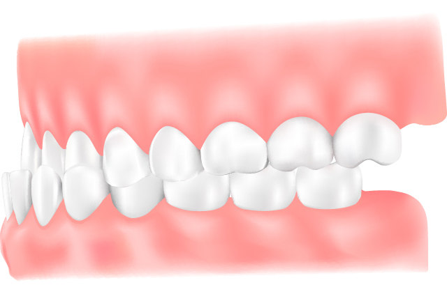 受け口(反対咬合・下顎前突)