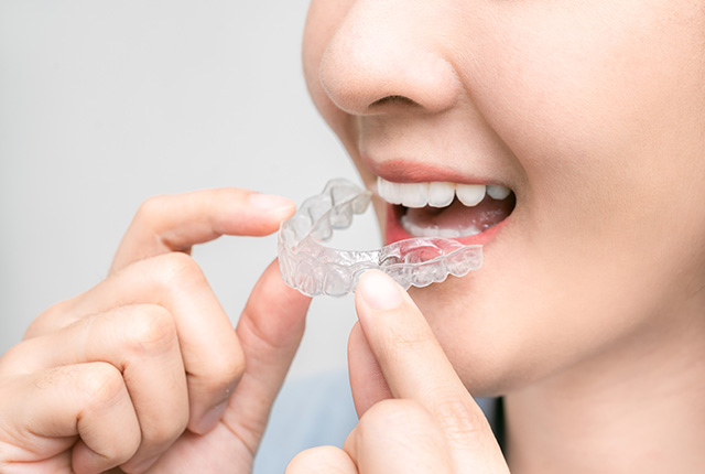 マウスピース型の矯正装置をつけようとする女性の口元