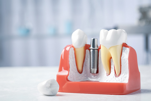 インプラントの仕組みが分かる模型が台の上に置いてある