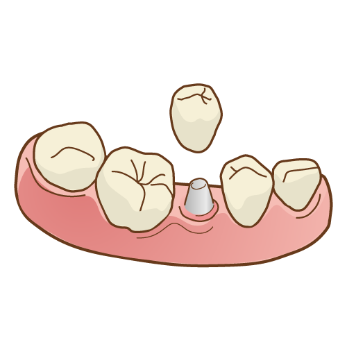 インプラントのイメージ図