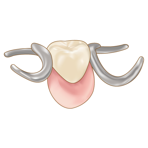 部分入れ歯のイメージ図