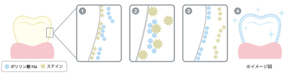 ポリリンホワイトニングの説明図