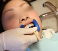 ホワイトニング専用ジェルを歯に塗る様子