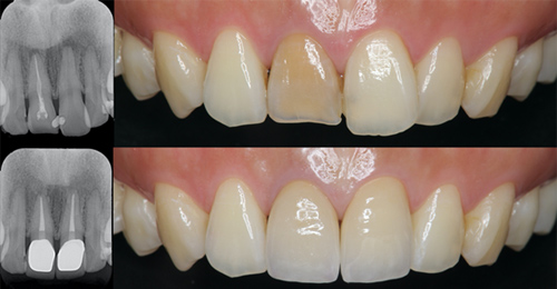 セラミックの被せ物の実例紹介