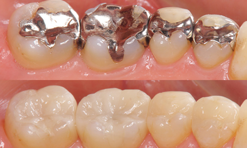 セラミックの詰め物の実例紹介