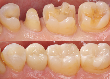 詰め物の処置前と後の実例