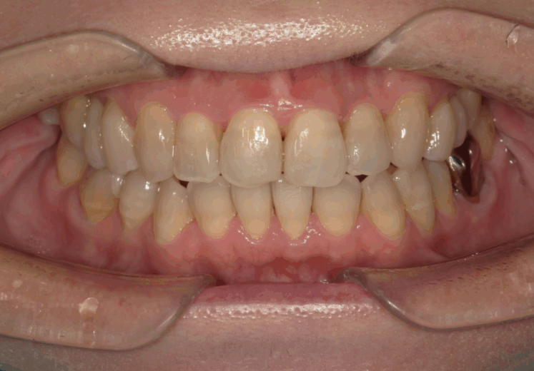 オープンバイト（開咬）のマウスピース矯正治療：治療後