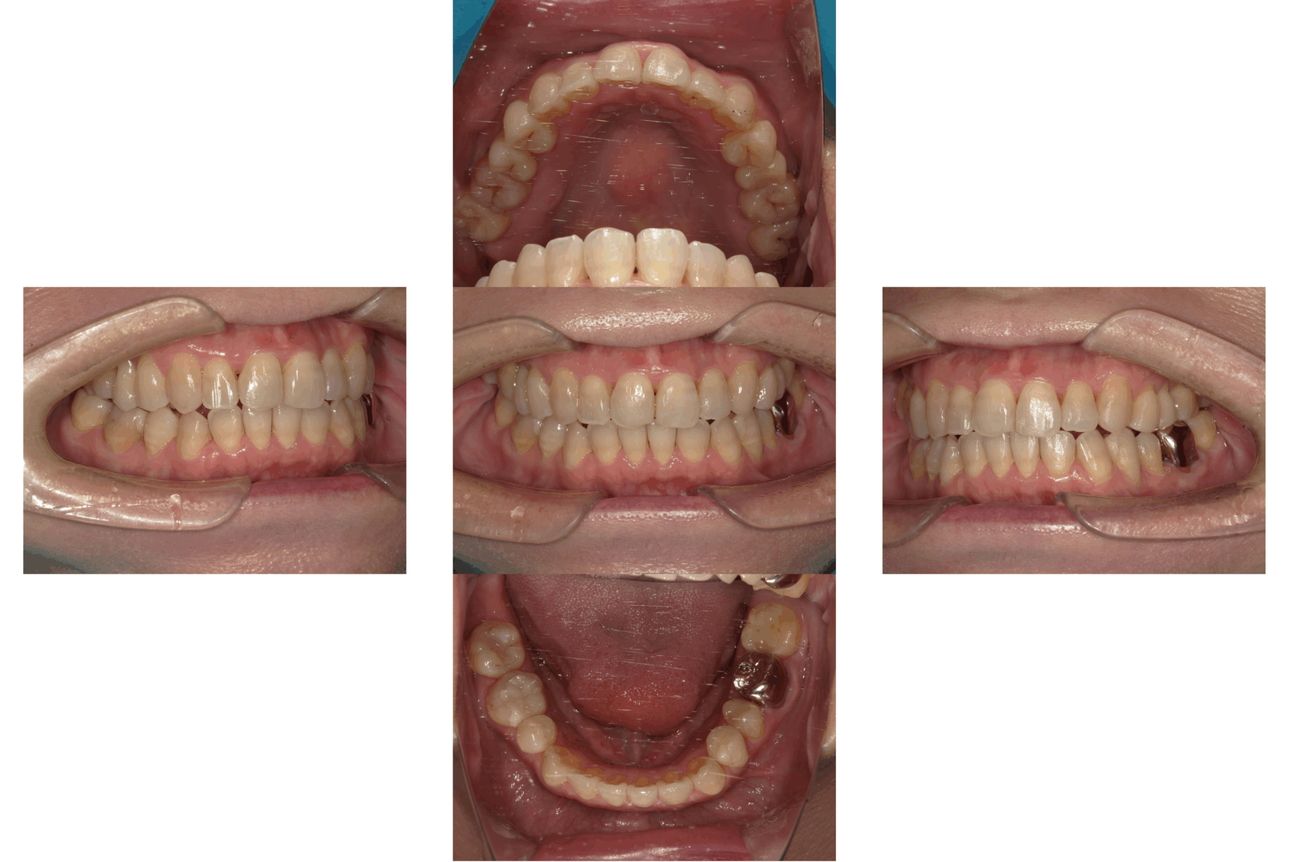 オープンバイト(開咬)のマウスピース矯正治療:治療後