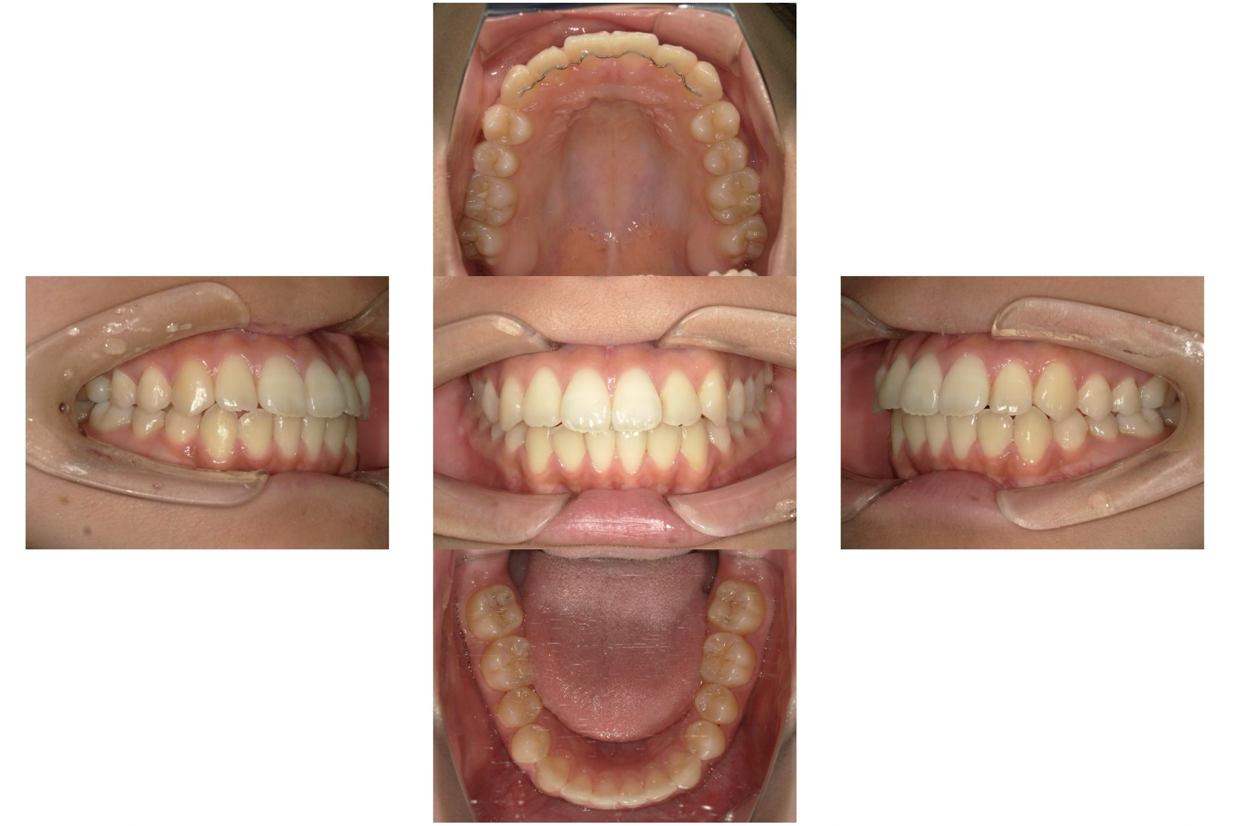 八重歯のマウスピース矯正治療:治療後