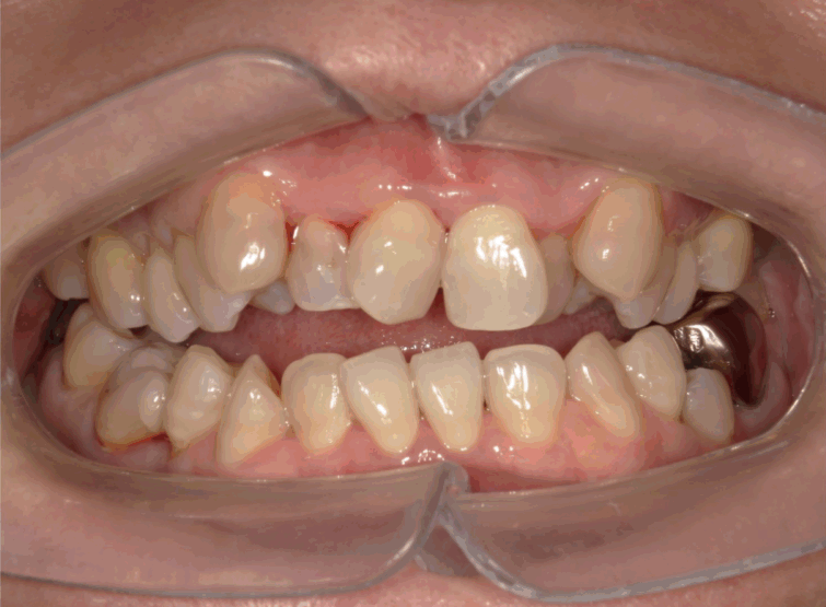 オープンバイト（開咬）のマウスピース矯正治療：治療前