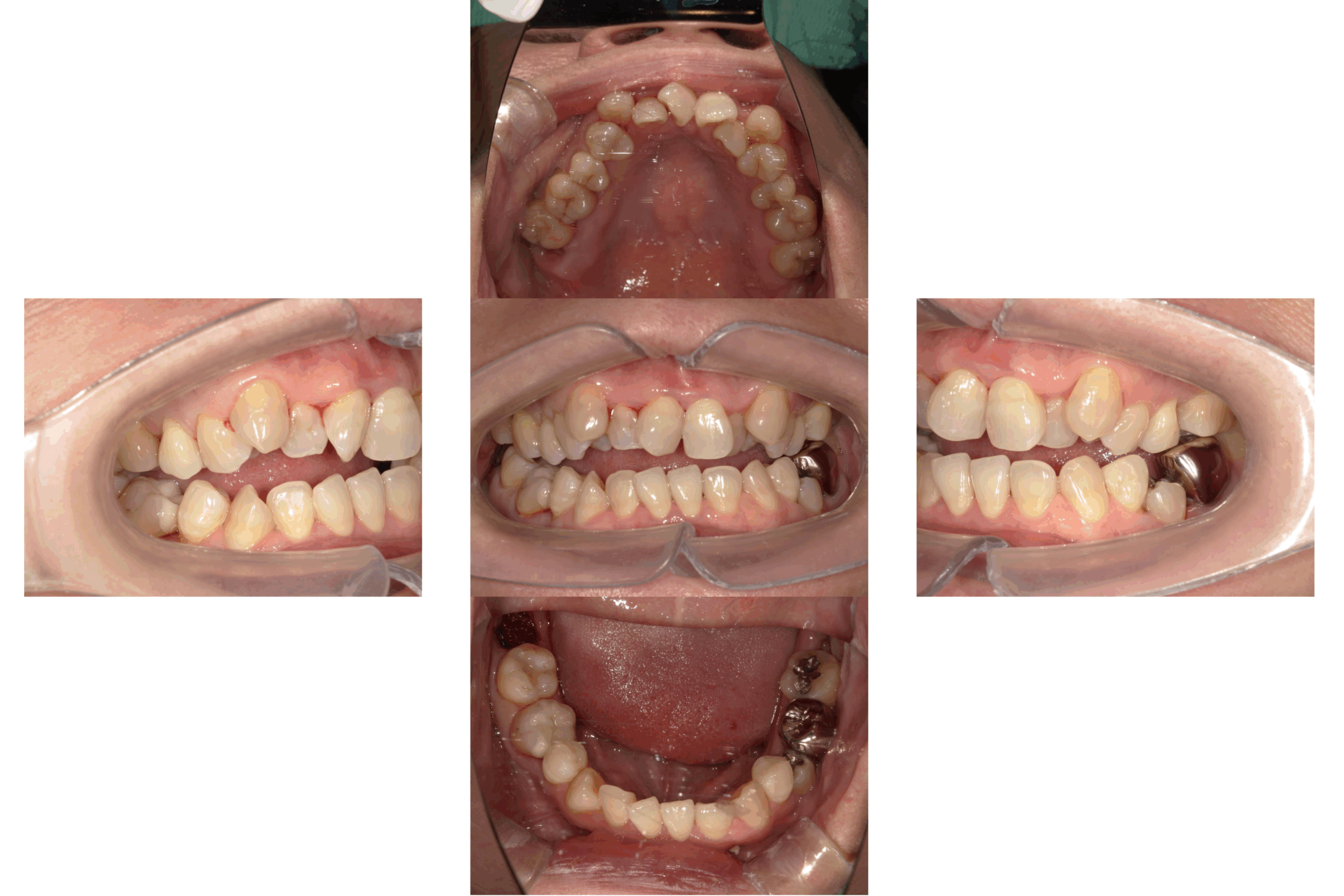 オープンバイト(開咬)のマウスピース矯正治療:治療前