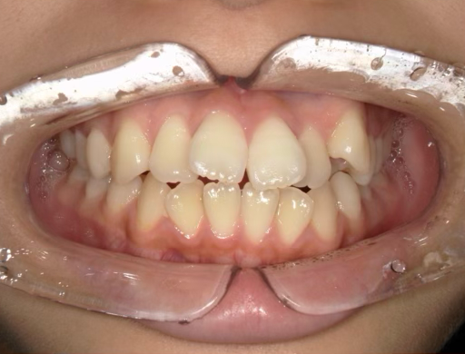 八重歯のマウスピース矯正治療：治療前
