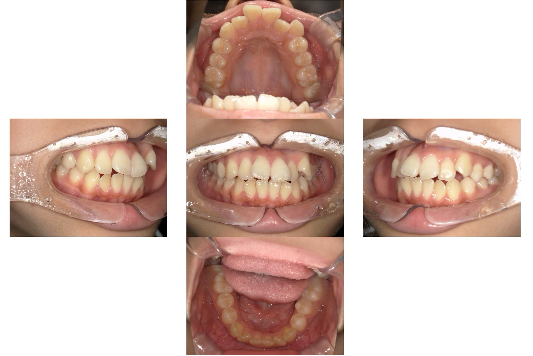 八重歯のマウスピース矯正治療:治療前